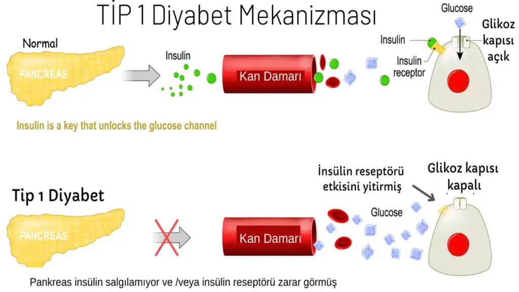 Tıp1 diyabet Mekanizması